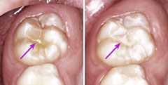 Zahn vor und nach der Fissurenversiegelung