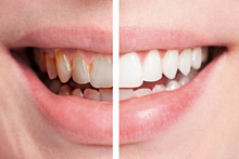 Zähne vor und nach dem Bleaching