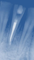 Der selbe Zahn mit korrekter Wurzelfüllung und ausgeheilter Knochenentzündung im Röntgenbild