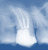 Mehrwurzeliger Zahn nach der Behandlung im Röntgenbild
